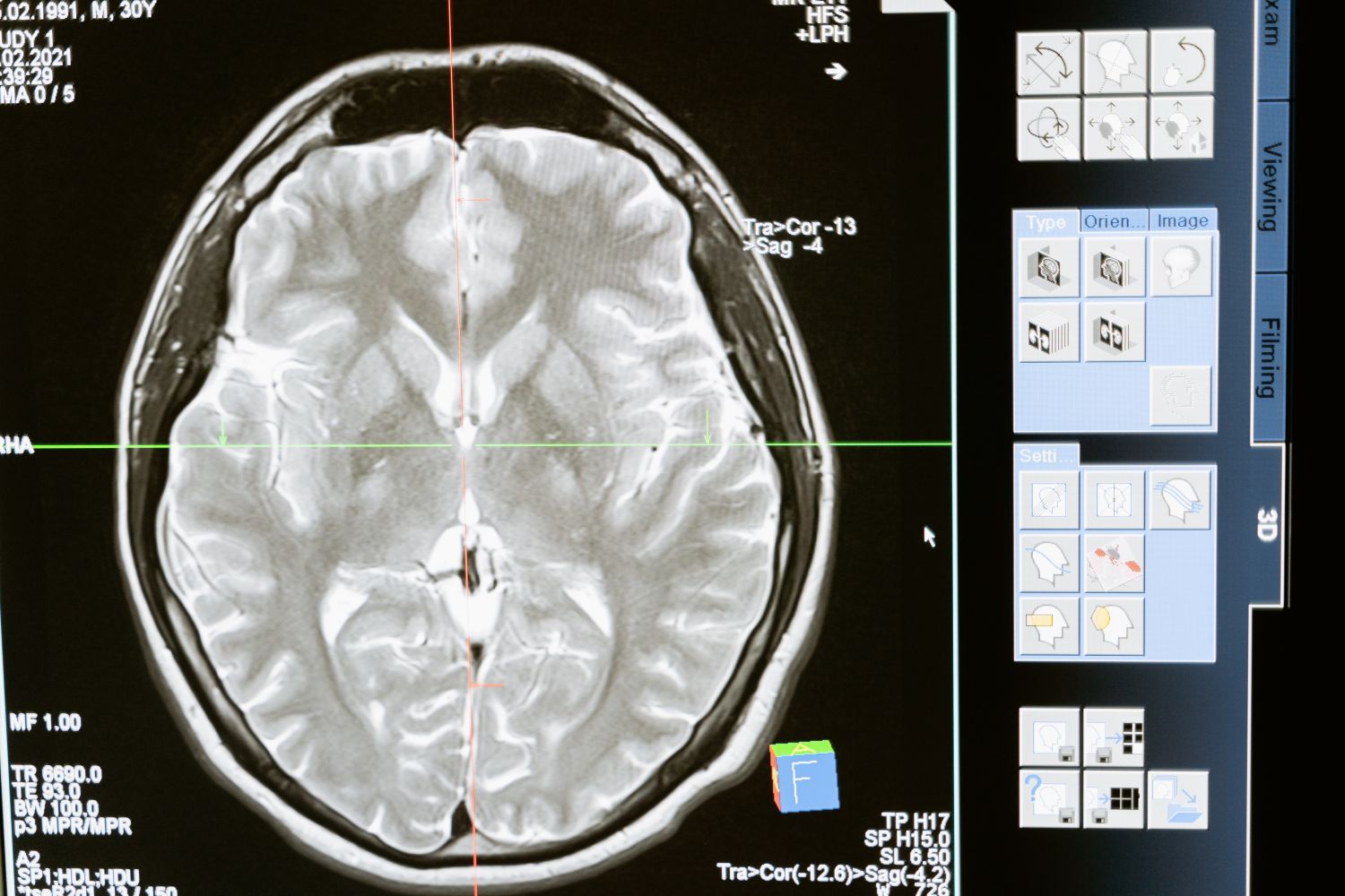 A brain scan of a person who has a head injury in a car accident